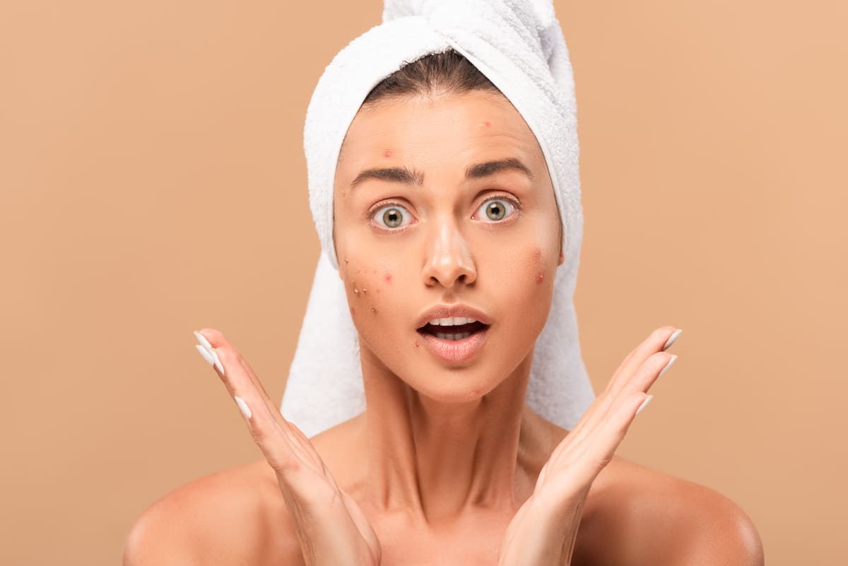 Comment se débarrasser de l'acné ?